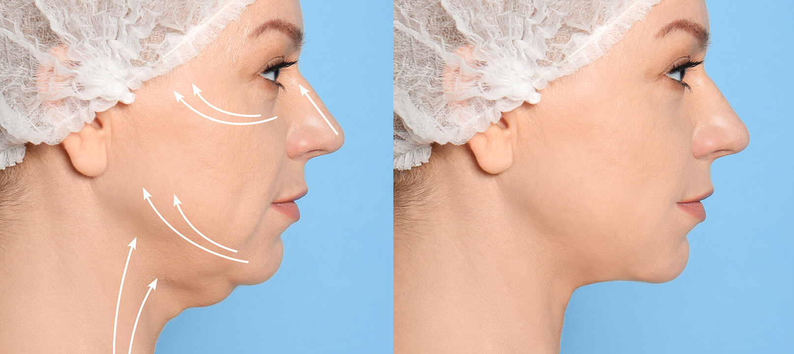 Jawline Contouring  Virginia, Washington D.C. and Maryland