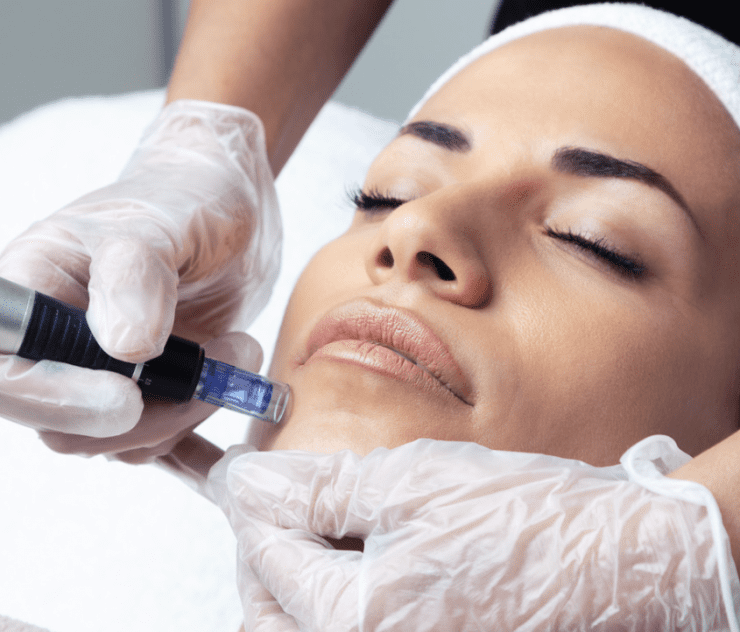 Microneedling Cost