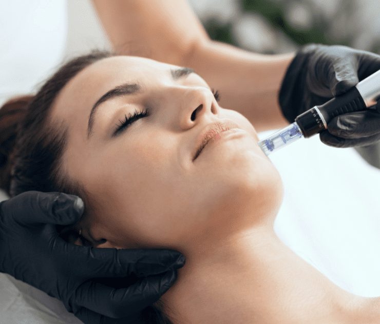 best microneedling and prp