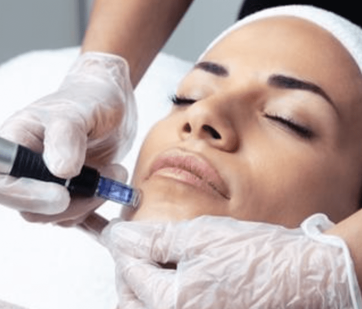 microneedling cost