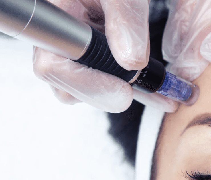 best microneedling treatment