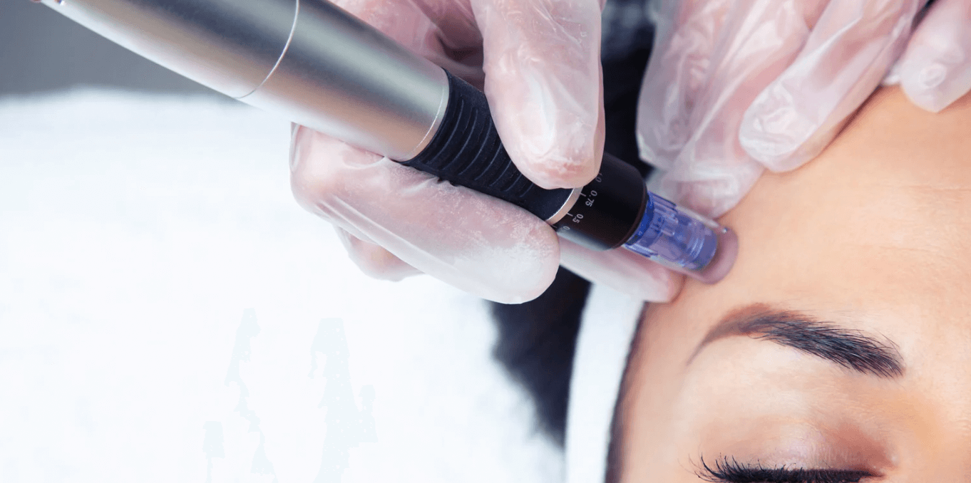 best microneedling treatment