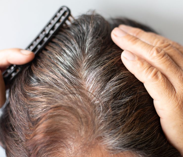 Best Hair Loss Treatment for Men