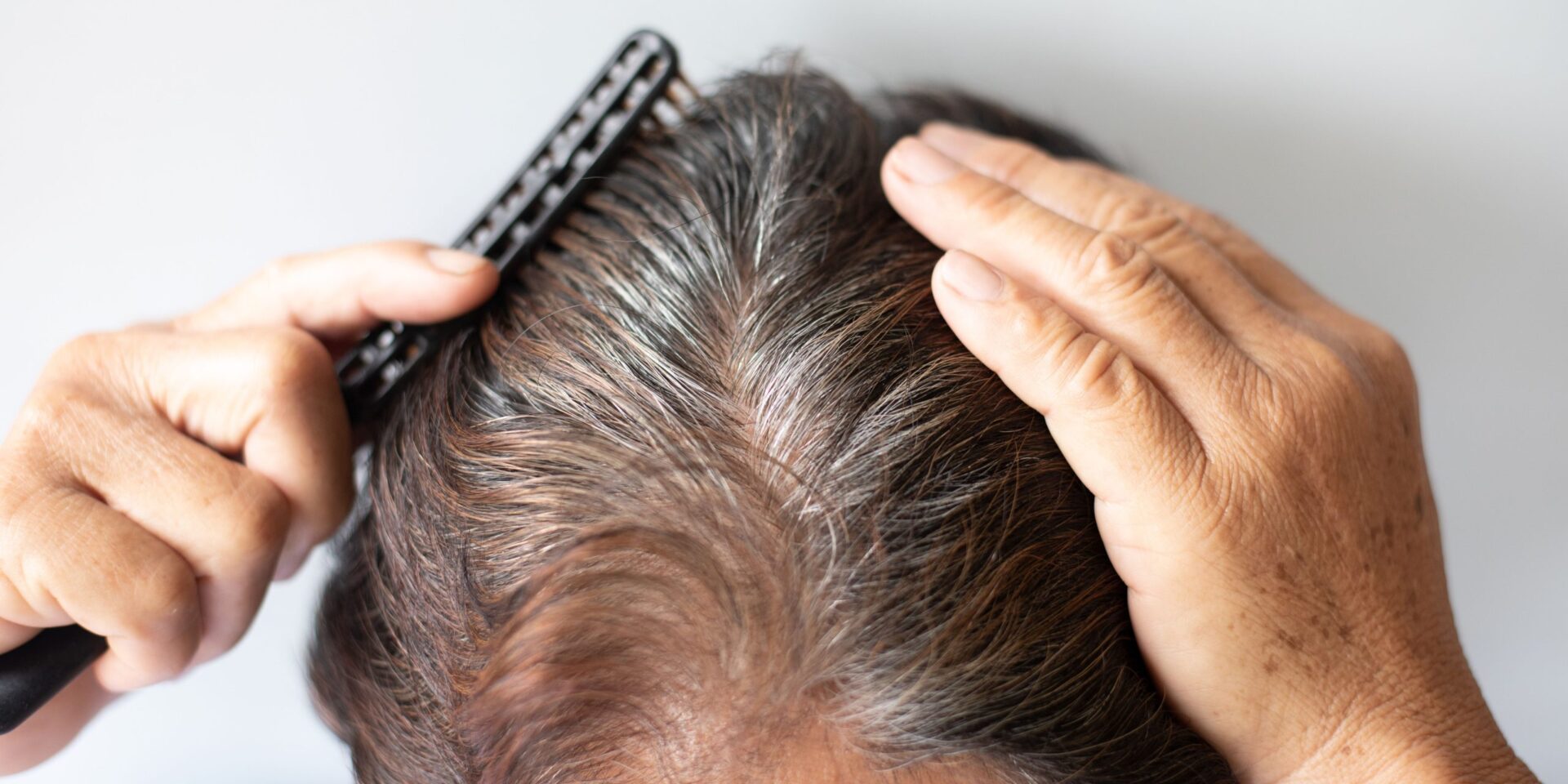 Best Hair Loss Treatment for Men