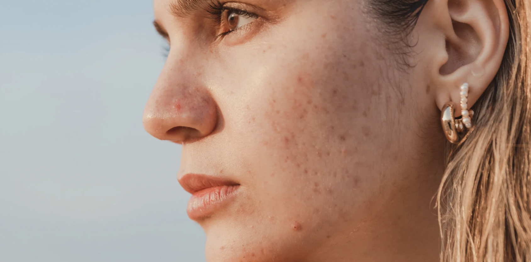 Acne Scars Specialist