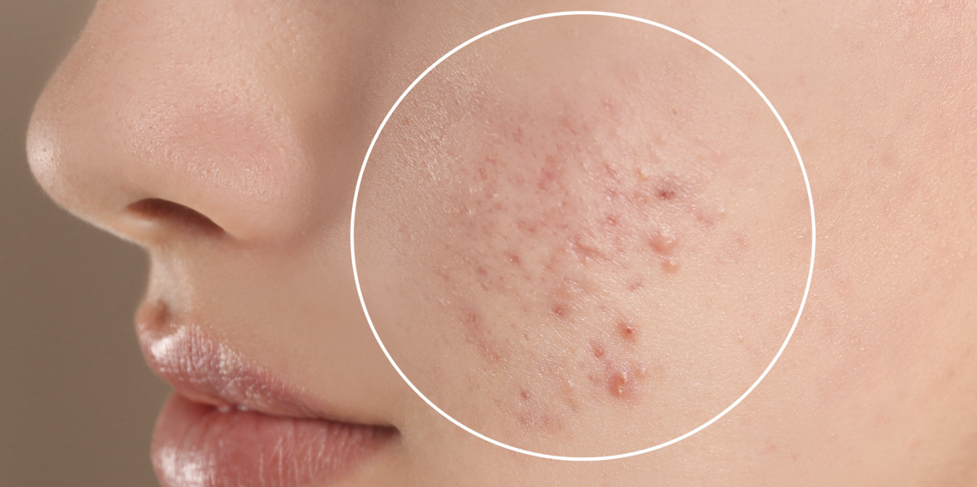 Acne Specialist in Maryland