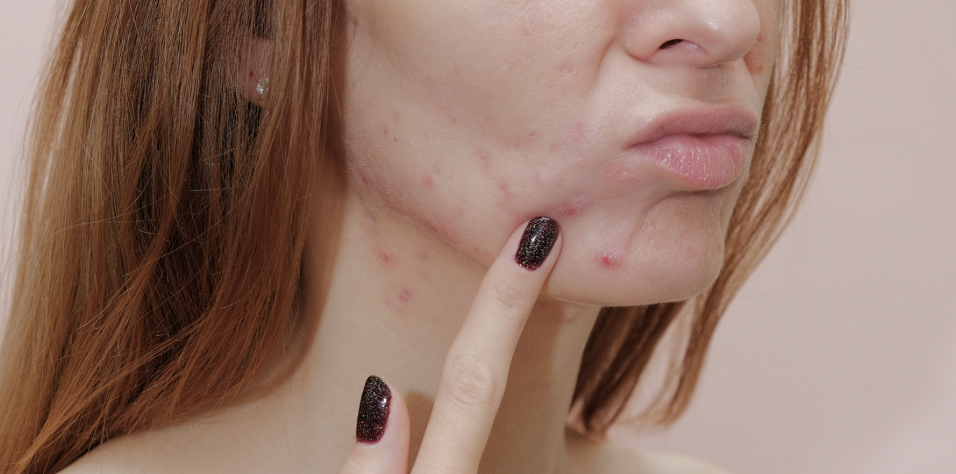 Best Acne Specialists in Bowie